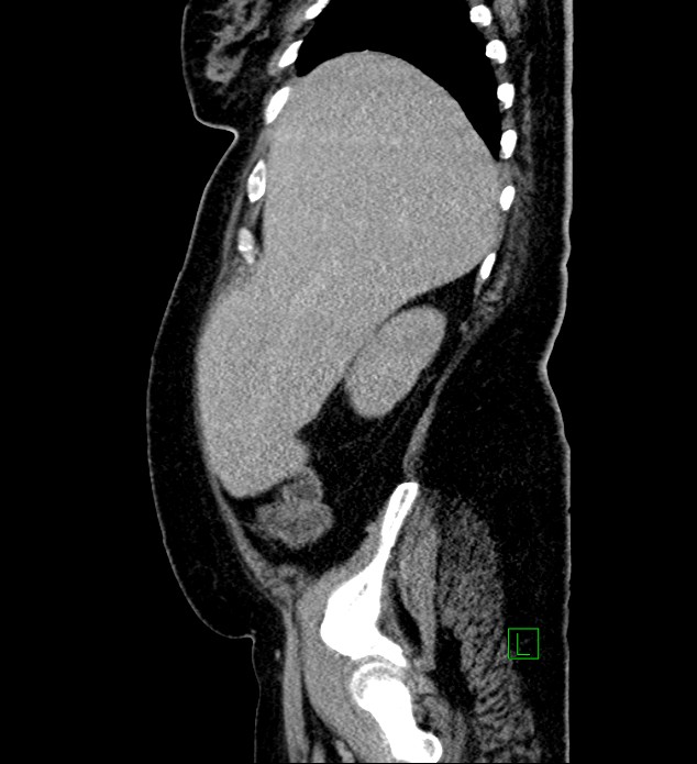 Chromophobe renal cell carcinoma (Radiopaedia 84239-99519 G 94).jpg