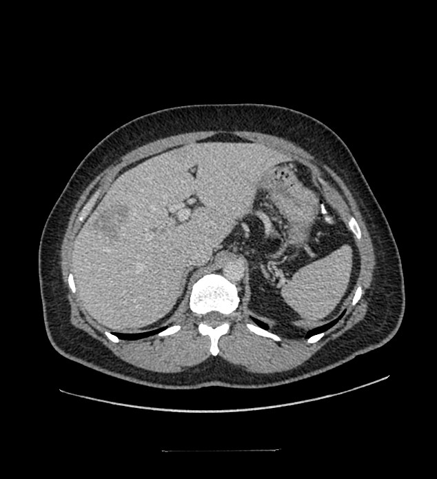 Chromophobe renal cell carcinoma (Radiopaedia 84337-99644 C 35).jpg