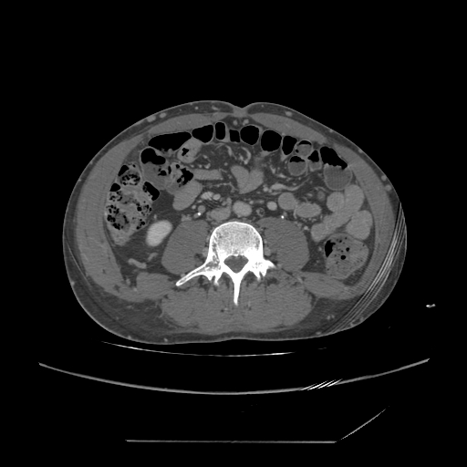 File:Chronic IVC thrombosis and resultant IVC filter malposition (Radiopaedia 81158-94800 A 132).jpg