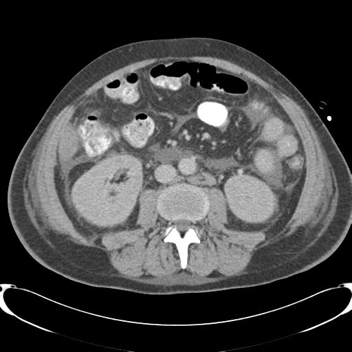 Chronic diverticulitis complicated by hepatic abscess and portal vein thrombosis (Radiopaedia 30301-30938 A 51).jpg