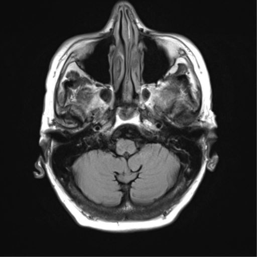 File:Chronic hypertensive encephalopathy (Radiopaedia 39993-42482 Axial FLAIR 4).png