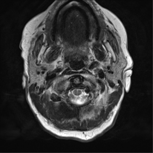 File:Chronic hypertensive encephalopathy (Radiopaedia 72844-83495 Axial T2 1).png