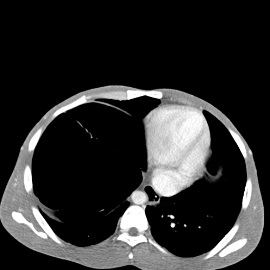 Chronic large bowel pseudo-obstruction (Radiopaedia 43181-46492 A 28).jpg