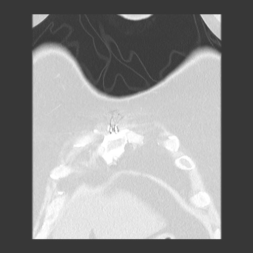 Chronic lung allograft dysfunction - restrictive form (Radiopaedia 60595-68316 Coronal lung window 18).jpg