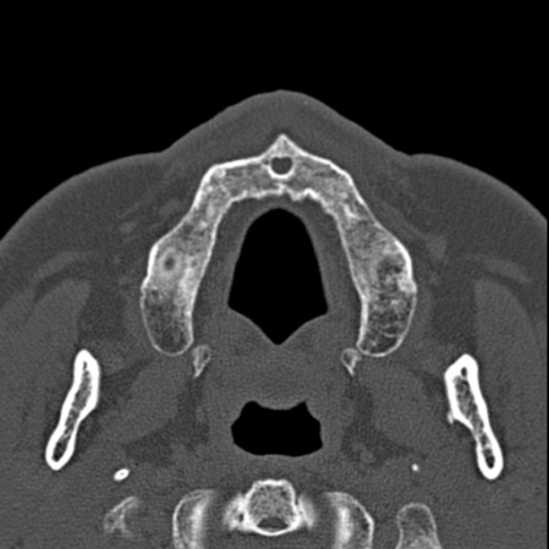 Chronic maxillary sinusitis (Radiopaedia 27879-28116 Axial bone window 2).jpg