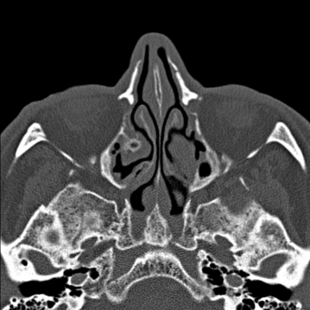 Chronic maxillary sinusitis (Radiopaedia 27879-28116 Axial bone window 25).jpg