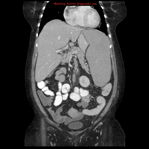 File:Chronic myeloid leukemia with splenic infarction (Radiopaedia 9178-9874 E 20).jpg