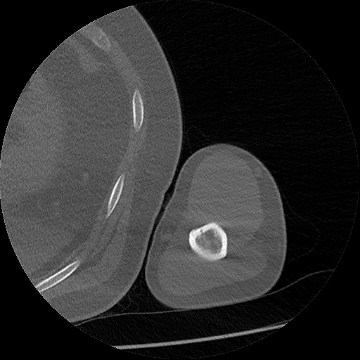 Chronic osteomyelitis (Radiopaedia 67597-76998 Axial bone window 44).jpg