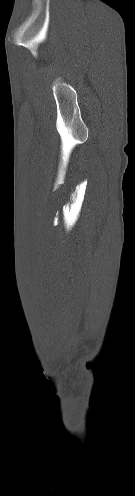 Chronic osteomyelitis (with sequestrum) (Radiopaedia 74813-85822 C 92).jpg