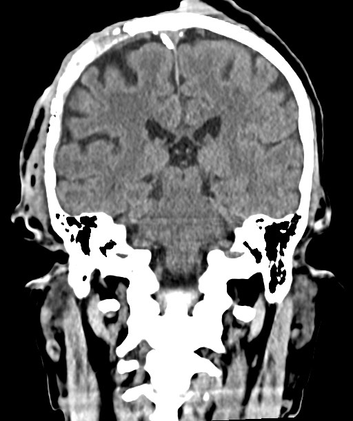 Chronic osteomyelitis - calvarial (severe) (Radiopaedia 69668-79616 Coronal non-contrast 43).jpg
