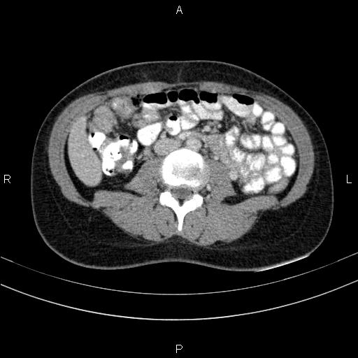 Chronic pancreatitis (Radiopaedia 64576-73450 C 92).jpg