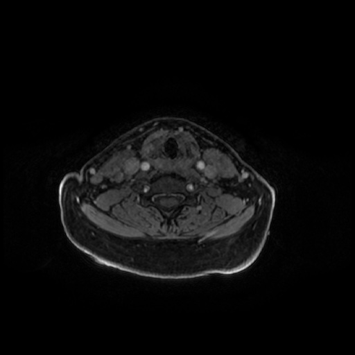 Chronic submandibular sialadenitis (Radiopaedia 61852-69885 Axial T1 C+ fat sat 19).jpg