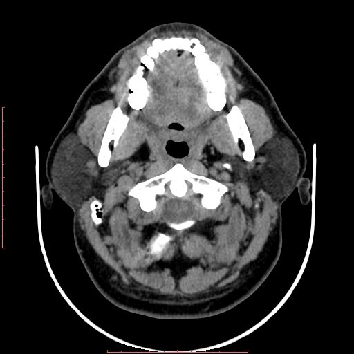 Chronic submandibular sialolithiasis (Radiopaedia 69817-79814 Axial non-contrast 60).jpg