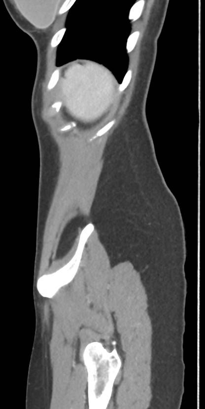 Circumaortic left renal vein with a duplicated retroaortic vein (Radiopaedia 91668-109398 C 115).jpg