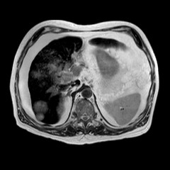 File:Cirrhosis and hepatocellular carcinoma in the setting of hemochromatosis (Radiopaedia 75394-86594 Axial T2 18).jpg