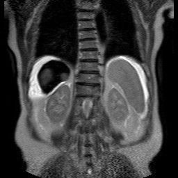 File:Cirrhosis and hepatocellular carcinoma in the setting of hemochromatosis (Radiopaedia 75394-86594 Coronal T2 23).jpg