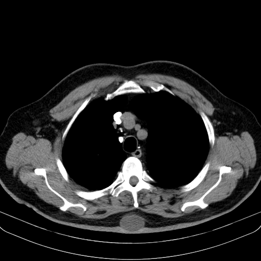 File:Classic complicated silicosis (Radiopaedia 49720-54961 Axial liver window 13).jpg
