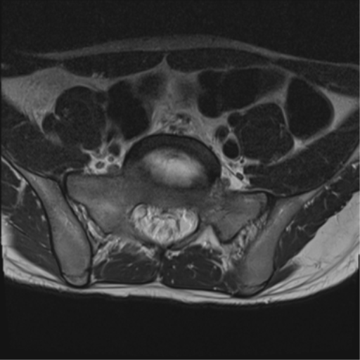 File:Clear cell meningoma - lumbar spine (Radiopaedia 60116-67690 Axial T2 4).png