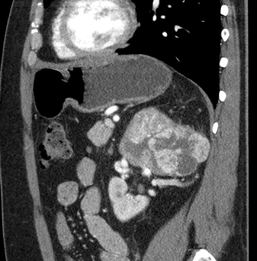 File:Clear cell renal cell carcinoma (Radiopaedia 61449-69393 D 31).jpg