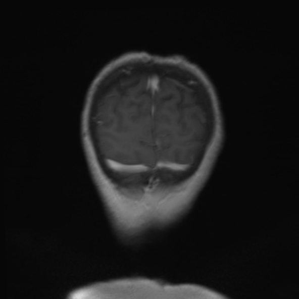 File:Clival meningioma (Radiopaedia 53278-59248 F 26).jpg