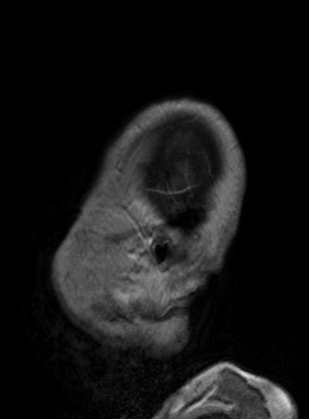 Clival meningioma (Radiopaedia 53278-59248 Sagittal T1 C+ 130).jpg