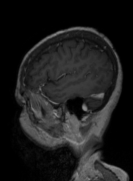 Clival meningioma (Radiopaedia 53278-59248 Sagittal T1 C+ 345).jpg