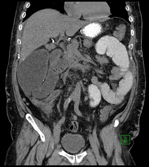 Closed-loop small bowel obstruction-internal hernia (Radiopaedia 78439-91096 Coronal non-contrast 47).jpg