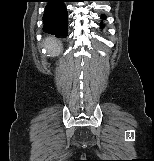 Closed loop obstruction - internal hernia into nephrectomy bed (Radiopaedia 59867-67320 B 124).jpg