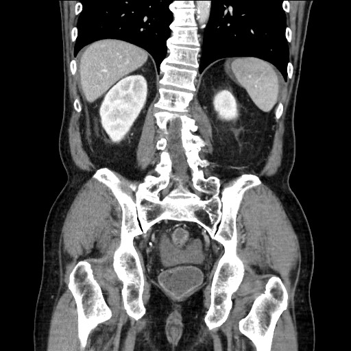Closed loop obstruction due to adhesive band, resulting in small bowel ischemia and resection (Radiopaedia 83835-99023 E 92).jpg