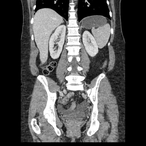Closed loop small bowel obstruction (Radiopaedia 65403-74451 B 72).jpg
