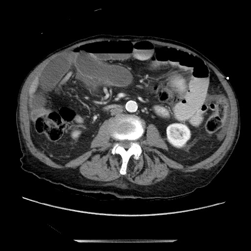 File:Closed loop small bowel obstruction - adhesive disease and hemorrhagic ischemia (Radiopaedia 86831-102990 A 99).jpg