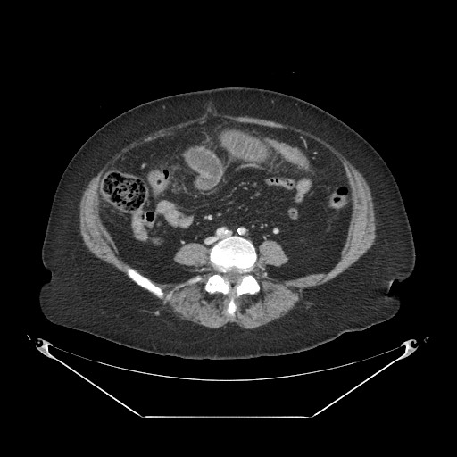 File:Closed loop small bowel obstruction - internal hernia (Radiopaedia 65402-74450 A 79).jpg