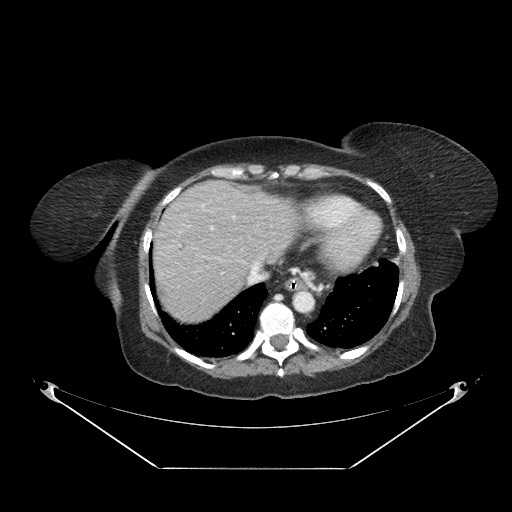 Closed loop small bowel obstruction - internal hernia (Radiopaedia 65402-74450 A 9).jpg