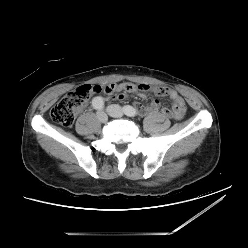 Closed loop small bowel obstruction - omental adhesion causing "internal hernia" (Radiopaedia 85129-100682 A 114).jpg