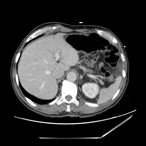 Closed loop small bowel obstruction - omental adhesion causing "internal hernia" (Radiopaedia 85129-100682 A 29).jpg