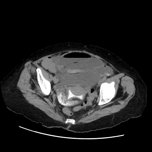 Closed loop small bowel obstruction due to adhesive band, with intramural hemorrhage and ischemia (Radiopaedia 83831-99017 Axial non-contrast 137).jpg