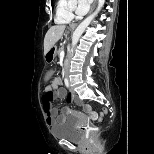 Closed loop small bowel obstruction due to adhesive band, with intramural hemorrhage and ischemia (Radiopaedia 83831-99017 D 106).jpg