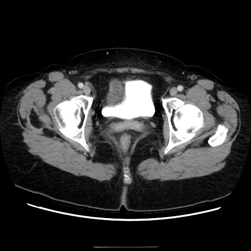 Closed loop small bowel obstruction due to adhesive bands - early and late images (Radiopaedia 83830-99015 A 159).jpg