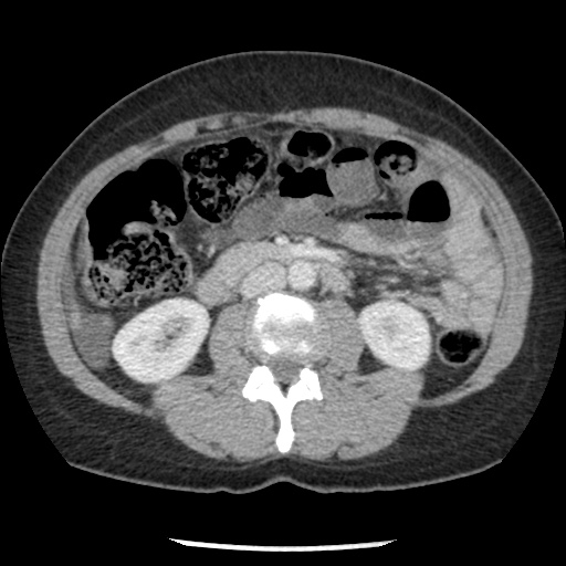 Closed loop small bowel obstruction due to trans-omental herniation (Radiopaedia 35593-37109 A 42).jpg