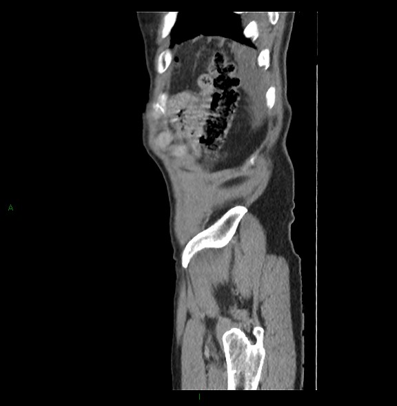 Closed loop small bowel obstruction with ischemia (Radiopaedia 84180-99456 C 84).jpg