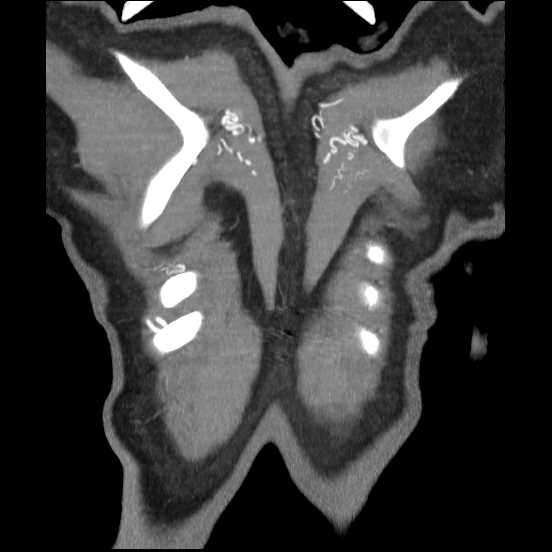 Coarctation of the aorta (Radiopaedia 67609-77010 B 3).jpg
