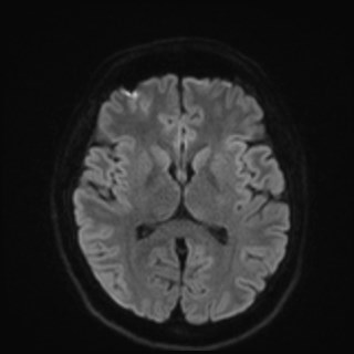 Cochlear incomplete partition type III associated with hypothalamic hamartoma (Radiopaedia 88756-105498 Axial DWI 62).jpg