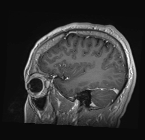 Cochlear incomplete partition type III associated with hypothalamic hamartoma (Radiopaedia 88756-105498 Sagittal T1 C+ 14).jpg
