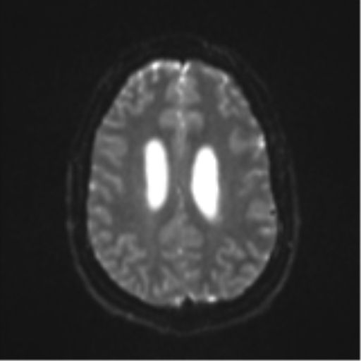 Colloid cyst (Radiopaedia 44510-48181 Axial DWI 21).png
