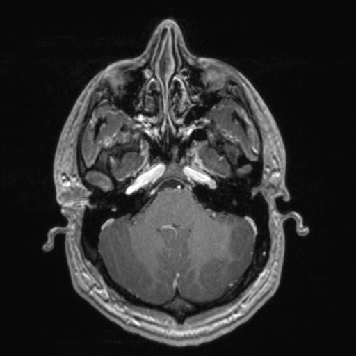 File:Colloid cyst (Radiopaedia 44510-48181 Axial T1 C+ 50).png