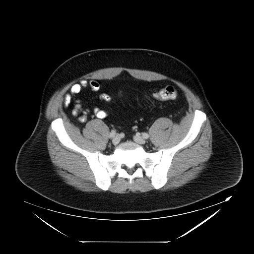 File:Colocolic intussusception due to lipoma (Radiopaedia 73712-84508 Axial 88).jpg