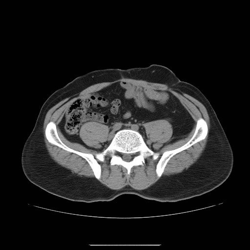 File:Colocutaneous fistula in Crohn's disease (Radiopaedia 29586-30093 Axial non-contrast 22).jpg
