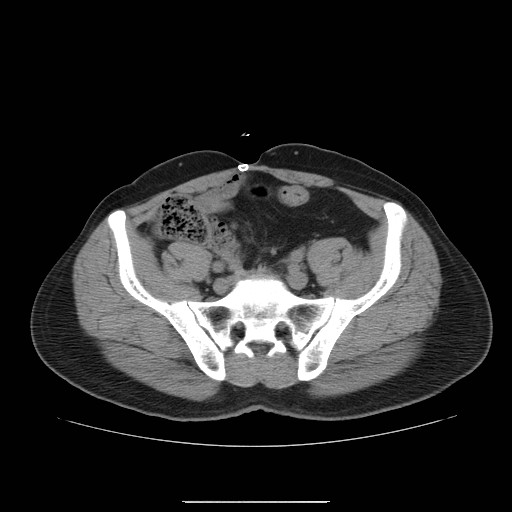 File:Colocutaneous fistula in Crohn's disease (Radiopaedia 29586-30093 Axial non-contrast 28).jpg