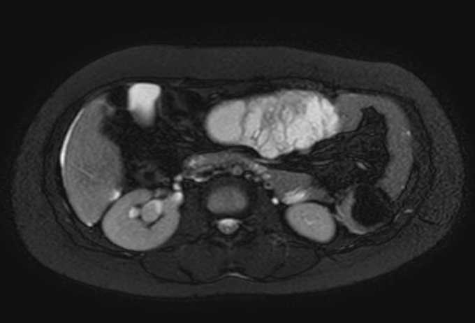 Colon adenocarcinoma with Krukenberg tumors, advanced pregnancy (Radiopaedia 67279-76645 Axial T2 SPAIR 48).jpg