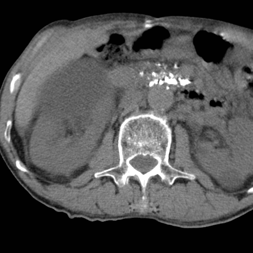 File:Colon cancer with calcified liver metastasis (Radiopaedia 74423-85309 Axial non-contrast 40).jpg